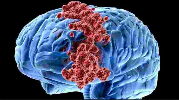 Os vírus mataram as células cancerígenas do cérebro 48 horas após a infecção Imagem: iStock